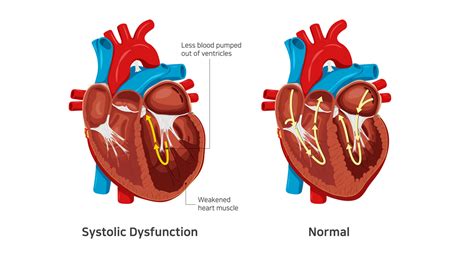 chronic heart failure with left ventricular systolic.